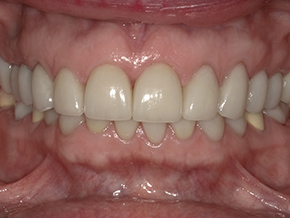 The image shows a close-up view of a person s mouth with a set of teeth, featuring a pinkish gumline and yellowed enamel.