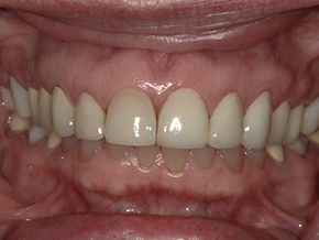 The image shows a close-up view of an open mouth with teeth, revealing a dental implant on the top left side, and a partial denture on the bottom right.