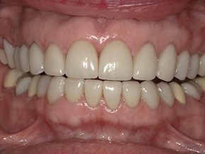The image shows a close-up view of an open mouth displaying a set of teeth with varying shades of yellow and white, against a blurred background that suggests a dental office setting.