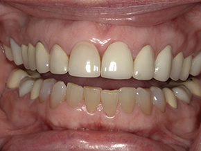 The image shows a close-up view of a person s teeth with an open mouth, revealing a set of dentures or artificial teeth.