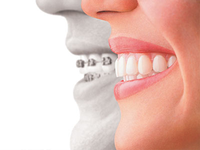 The image features a woman s smiling face with an overlay of a dental implant advertisement showing a side view of a person s teeth, emphasizing the transformation from a missing tooth to a smile with a dental implant.