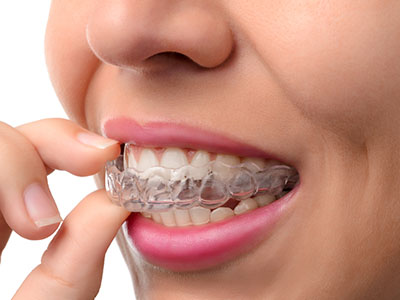 The image shows a person wearing an Invisalign aligner tray, with their mouth open slightly, revealing the clear plastic appliance used for teeth straightening.