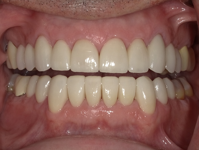 The image displays a close-up view of a person s mouth showing a wide smile with white teeth and pink gums, against a neutral background.
