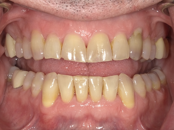 The image shows a close-up view of a person s mouth with yellow teeth and gums, revealing a set of dentures.