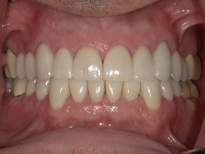 The image shows a close-up view of an open mouth with visible teeth, including front teeth with yellowing, and the lower lip partially visible at the bottom of the frame.