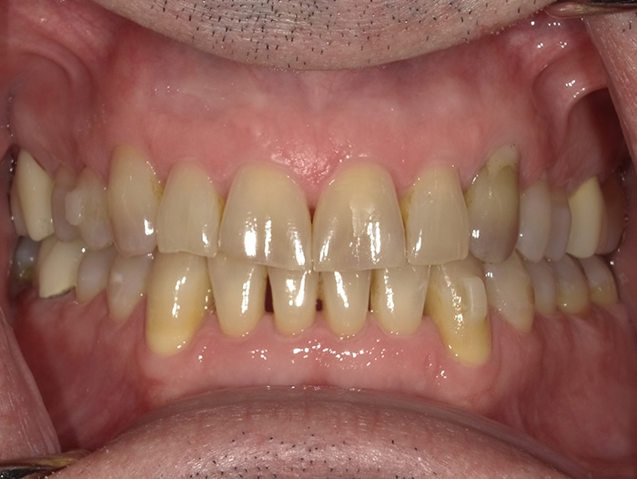 The image displays a close-up view of an open mouth showing teeth with yellow stains and gums with signs of inflammation, suggesting poor oral hygiene or dental issues.