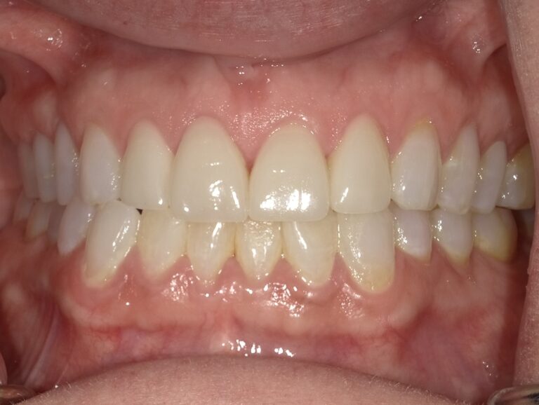 The image shows a person s teeth with yellow stains, indicating possible dental issues such as discoloration or decay.