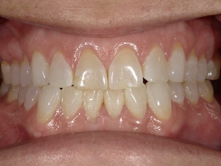 The image shows a close-up view of a person s teeth with yellow stains, set against a blurred background.