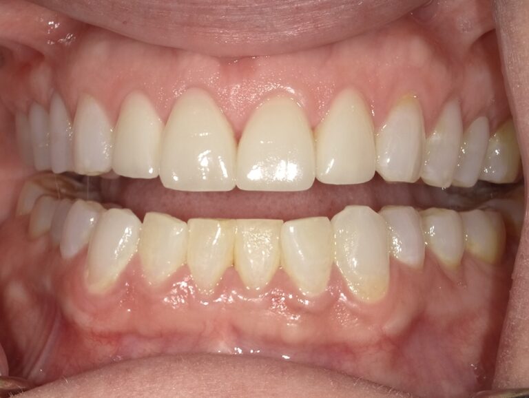 The image shows a close-up of an open mouth with yellow teeth and gums, revealing a dental implant on one side.