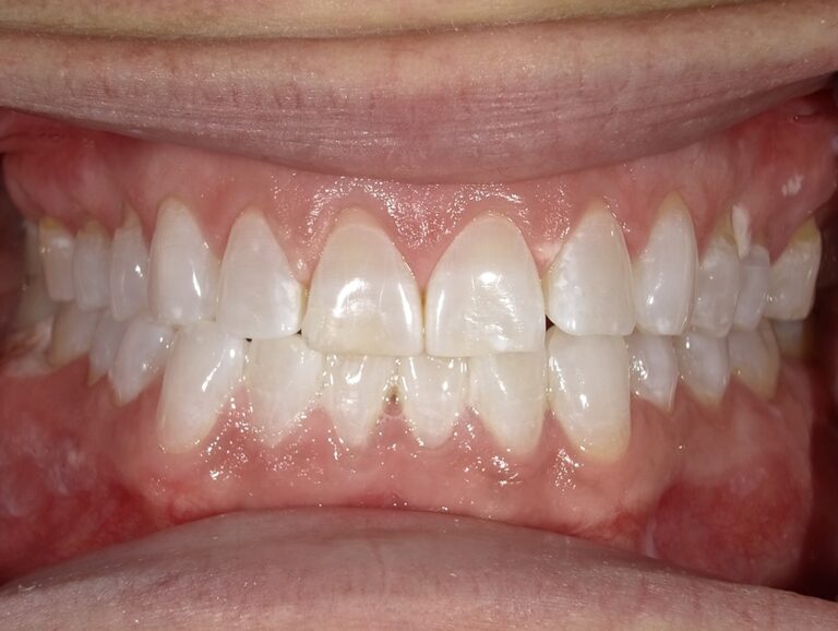 The image shows a close-up view of an individual s teeth with a noticeable amount of staining, particularly on the front teeth, which are prominently displayed.